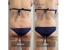 食事制限なし！肌のデコボコもキレイサイズダウン