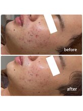 ミヌ 心斎橋(Minou)/ハーブピーリングbefore/after