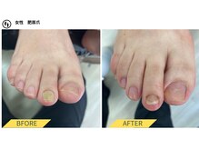 ふっとけ庵/肥厚爪ケア