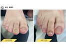 肥厚爪ケア