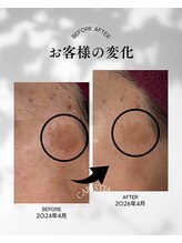 カリスティア(CARISTIA)/長年変化のなかったシミ