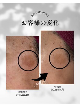 カリスティア(CARISTIA)/長年変化のなかったシミ