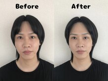 くにたちNyan鍼灸整体院/【小顔矯正】Before After 14