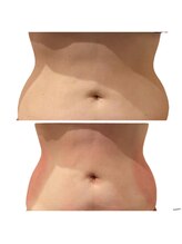 パウザ(PAUSA)/脂肪冷却ダイエット