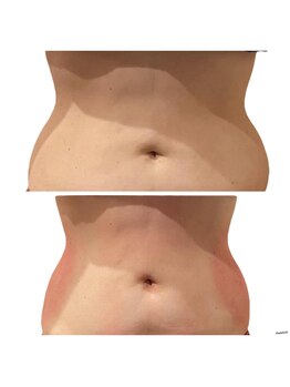 パウザ(PAUSA)/脂肪冷却ダイエット