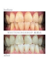 ホワイトニングショップ 姫路店/ホワイトニング