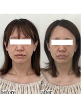 ヴェルシック(Belchic)/お顔が引き締まり弾力もアップ