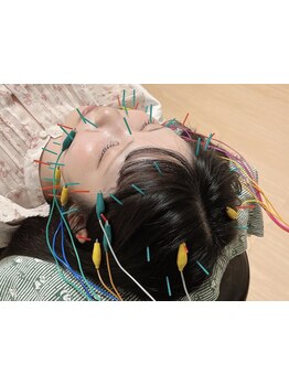 鍼灸施術を受けたい