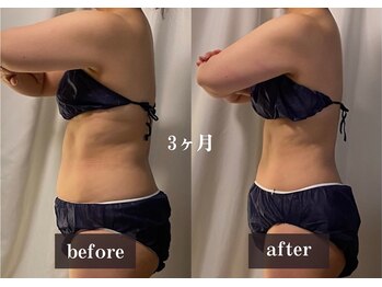 ダンデライオン 天神南店(dandelion)/痩身エステ3ヶ月
