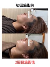 ケンビ(Kenbi)/美容鍼×レモンボトル《吉野町》