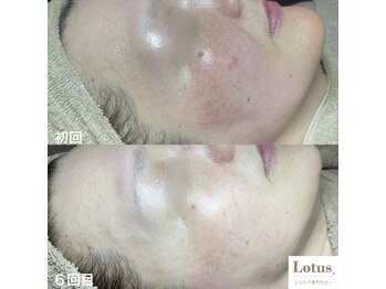シミケア専門サロン Lotus. 千早香椎店【シミ/シワ/毛穴/小顔】/ハリ・ツヤのあるお肌へ♪
