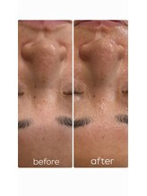 イノエ(inoe)/【一回の施術でこの変化…】