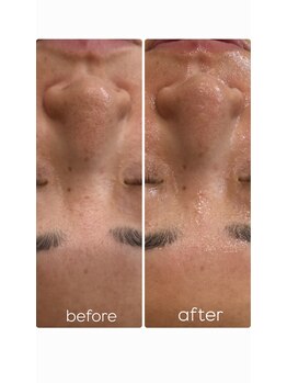 イノエ(inoe)/【一回の施術でこの変化…】