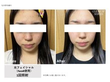 ドルチェビューティーサロン 戸塚安行店(Dolce Beauty Salon)/プラズマ光Facial_施術1回