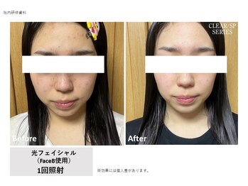 ドルチェビューティーサロン 戸塚安行店(Dolce Beauty Salon)/プラズマ光Facial_施術1回
