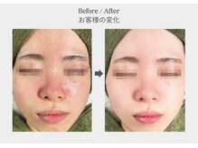 ベル 新橋(Belle)/ハーブピーリング×毛穴赤み