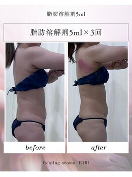 リリ(RIRI)の写真/【メリハリボディが欲しい方へ】希少な脂肪コントロール/増殖orを流す施術でハミ肉改善/老廃物を流す★