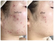 シェミー(CHEZ MEE)/【8回】変われます！若見え肌に 