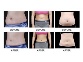 パウザ(PAUSA)/脂肪冷却ダイエット