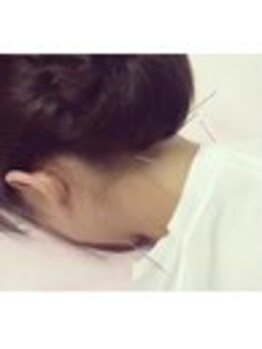 桜琴鍼灸治療院 赤坂店/首痛い辛い