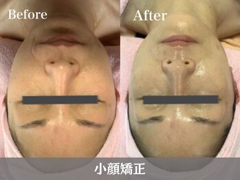 トウメイコガオ 横浜店/トウメイコガオで小顔エステ