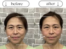 ビースタイル(B-style)/【美容鍼灸】ビフォーアフター