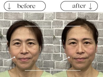 ビースタイル(B-style)/【美容鍼灸】ビフォーアフター