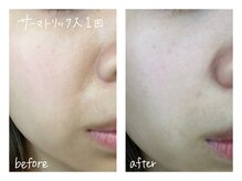 ミースプラス(me,as+)/高周波サーマ 全顔1回 (術直後)