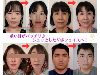 ブリティッシュロゼ/即効☆の小顔矯正の結果です
