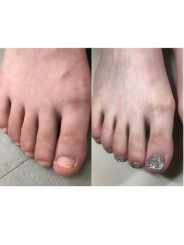 ティアラネイル 宇都宮/深爪矯正