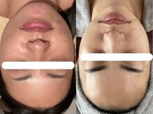 ジョーヌ(JAUNE)/赤み・大人ニキビも改善