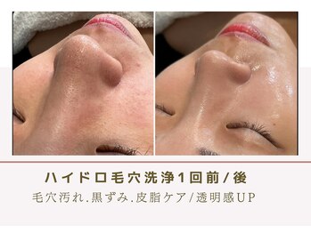 ルナビューティー 赤坂(LUNA beauty)/肌の黒ずみ、毛穴の開きにこれ!