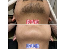 ベック(BECK)/１か所からでも脱毛可能★