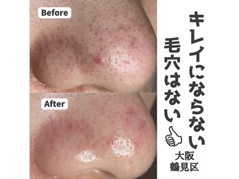 リッカロッカ(RIKKA&ROCCA)/キレイにならない毛穴はない！