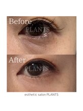 プランツ(PLANTS)/30代／３回／クマ目の下のたるみ