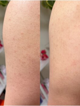 ソルティ サロン(salty salon)/ボディピーリング