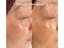 イーフェイス(e face)/プロセルセラピーズ美肌