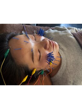 鍼灸施術を受けたい