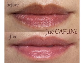 ジュエカフネ 広尾(JueCAFUNe)/《ルメラ》唇メラニンケア症例