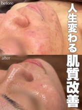 ジェノール 2nd beauty studio 姫路駅前店(JNOEL)/人生かわる肌質改善！