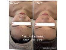 クリーンアンドビューティ 札幌(Clean&Beauty)/ニキビ撲滅、肌育のサロンです！