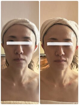 ジフィー(Gify)/筋膜リリースカッターFacial