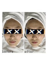 エクスクラメーションマーク(!!!)/超音波リフトアップ