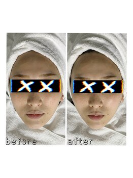 エクスクラメーションマーク(!!!)/超音波リフトアップ