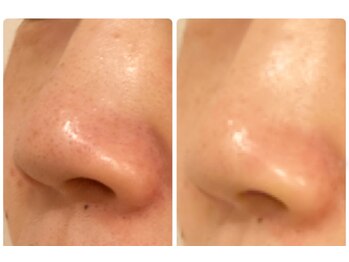 ティアエ(T-ae)/ハイドロフェイシャル 毛穴洗浄