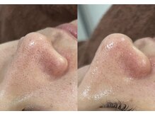 アイリーン(IRENE)/毛穴洗浄の効果実感♪