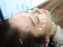 鍼灸整体院蒼/小顔美容鍼灸メニューあります♪