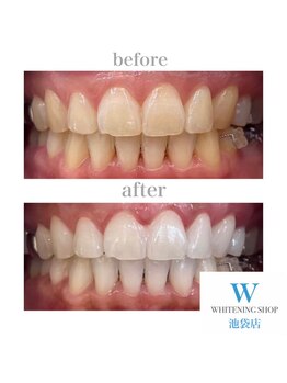 ホワイトニングショップ 池袋店/【ビフォーアフター】美白