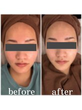 ディス イズ ミー エステティック(This is Me Aesthetic)/顔脱毛