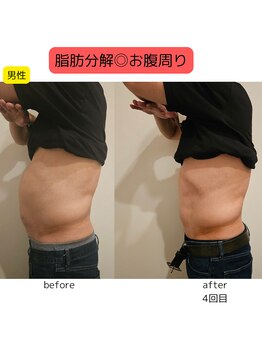 ウル バイ ラシック(Ulu by Lasic)/【脂肪分解】上半身ダイエット◎